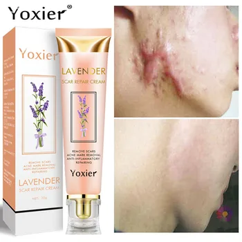Yoxier Sivke Brazgotina Repair Cream Acne Scar Removal Pigmentacije Korektor Odstranjevanje Strij Nemoteno Beljenje Kože Nego Brazgotin